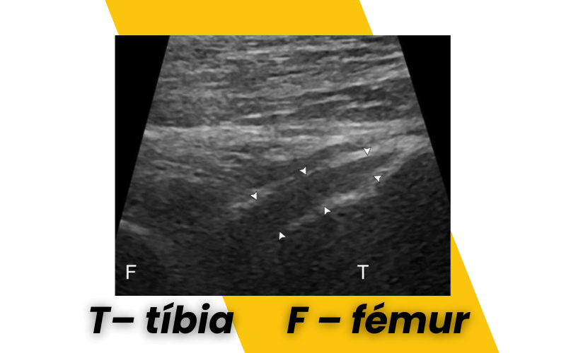 5. Evaluacion rodilla ecografia.png